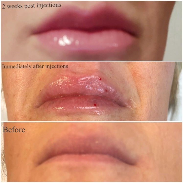 Lip Filler