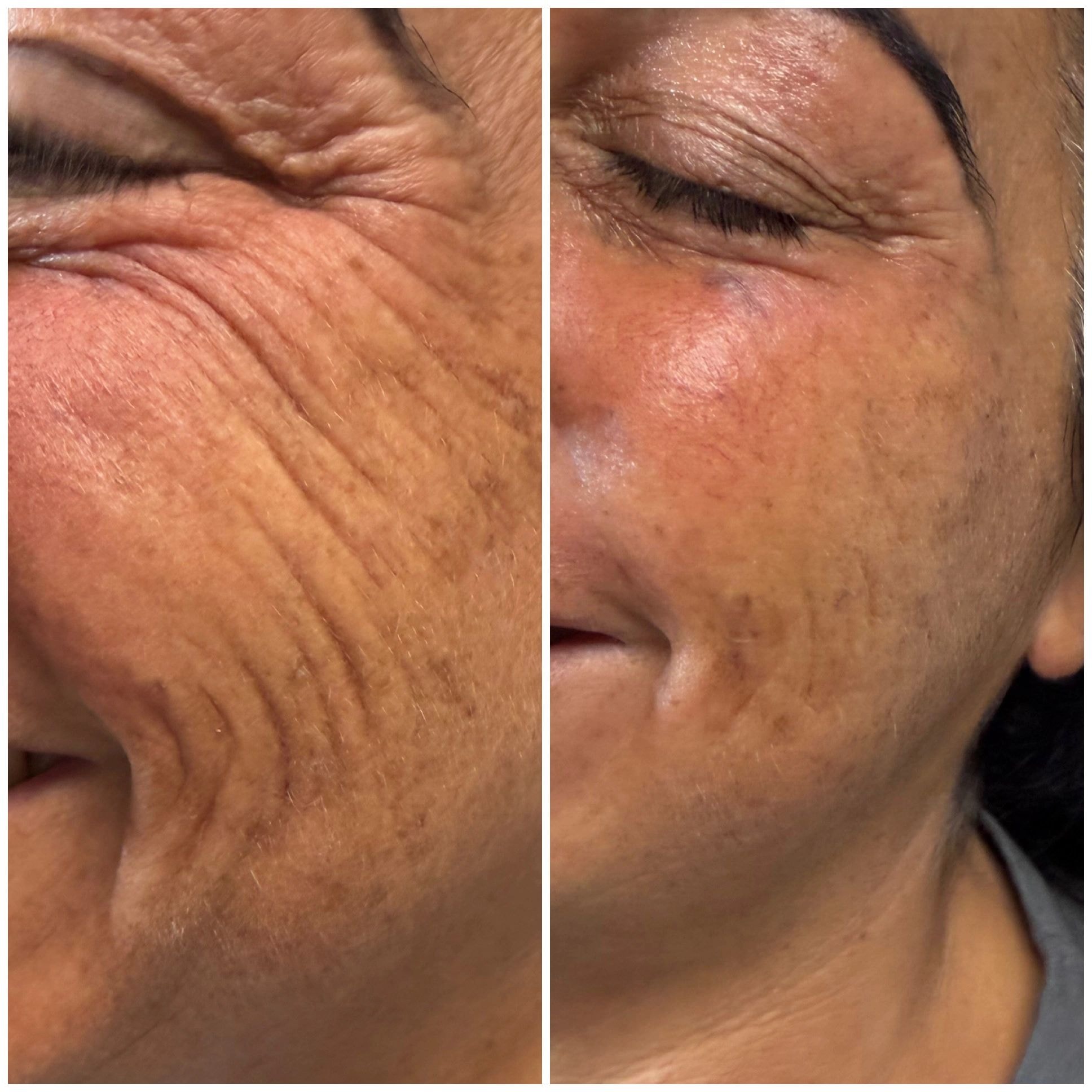 Skin Texture Improvement